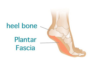 arch pain plantar fasciitis