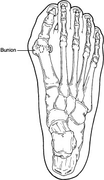 bunion
